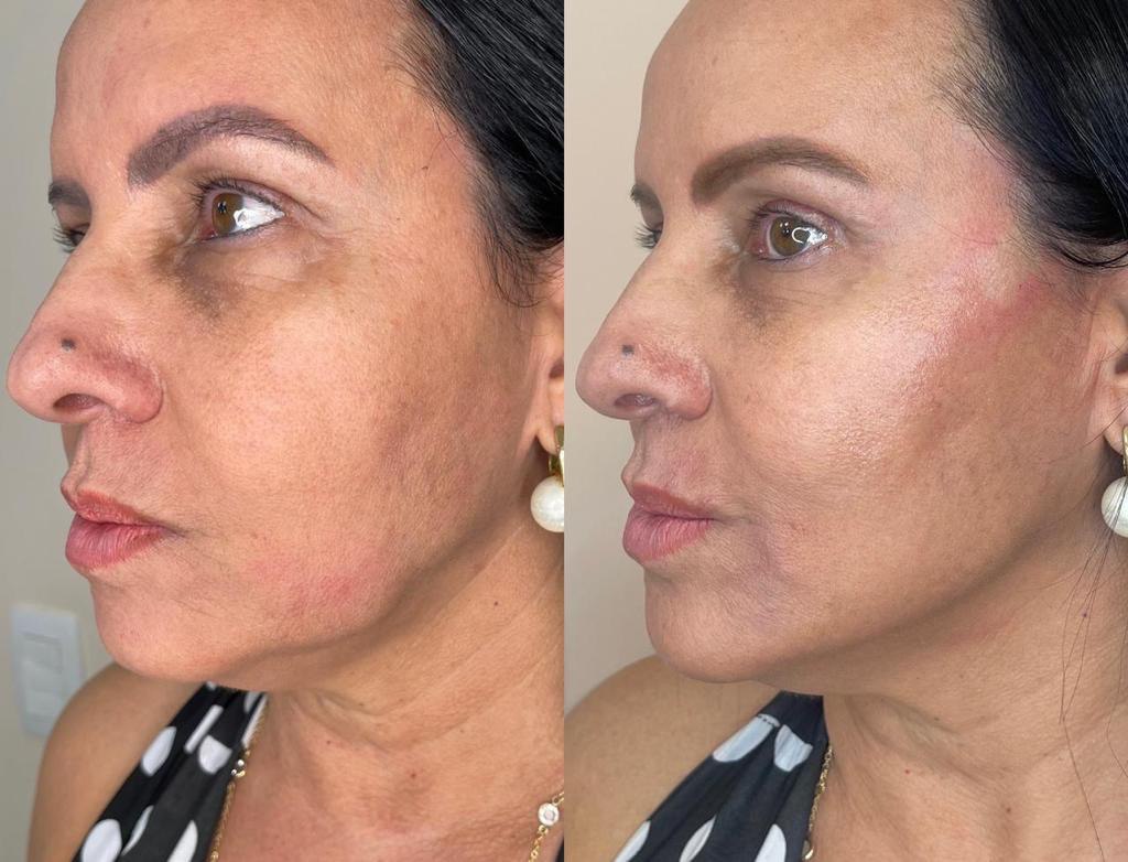 rejuvenescimento facial